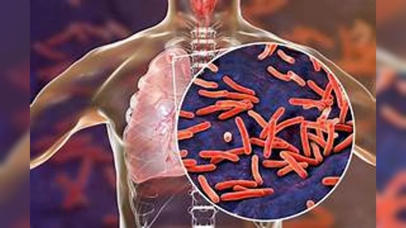 Aumentaron un 38% los casos de tuberculosis en Argentina